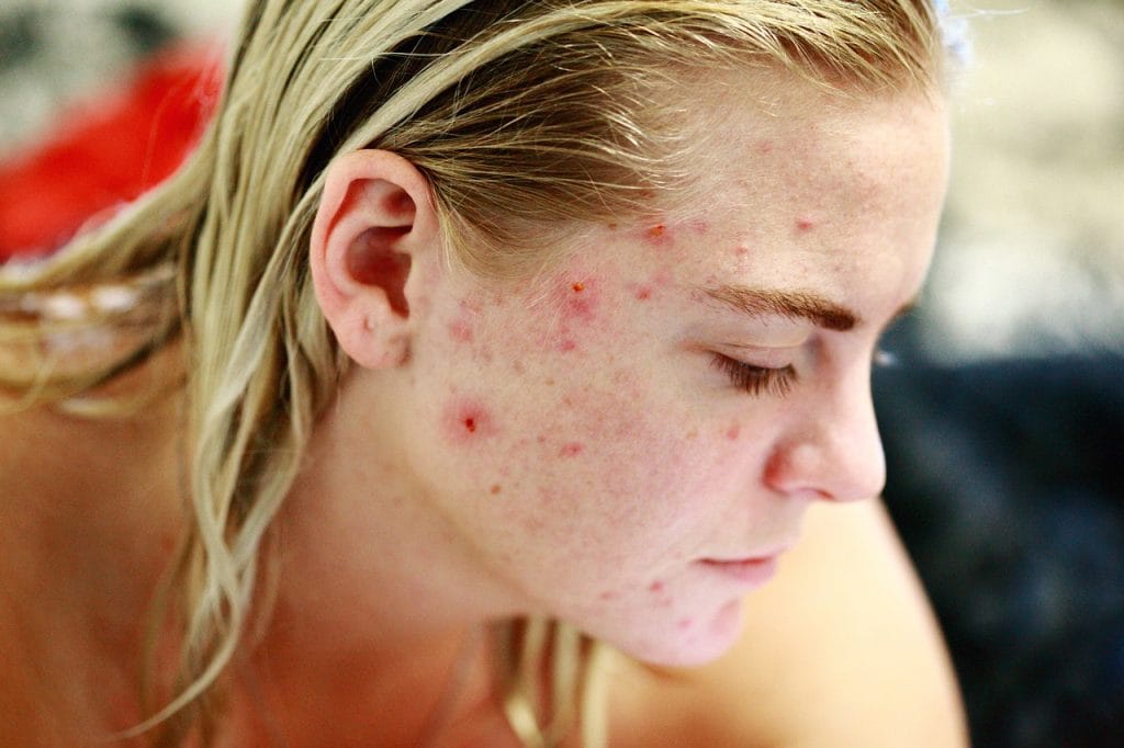 Acne Tratamento: Você Não Vai Acreditar no Que Funciona!